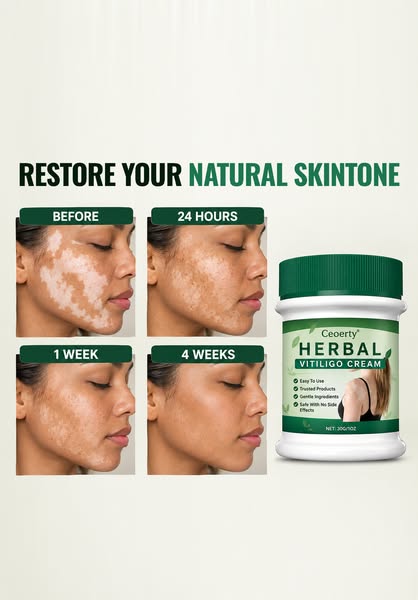 Fast and easy fix for vitiligo.