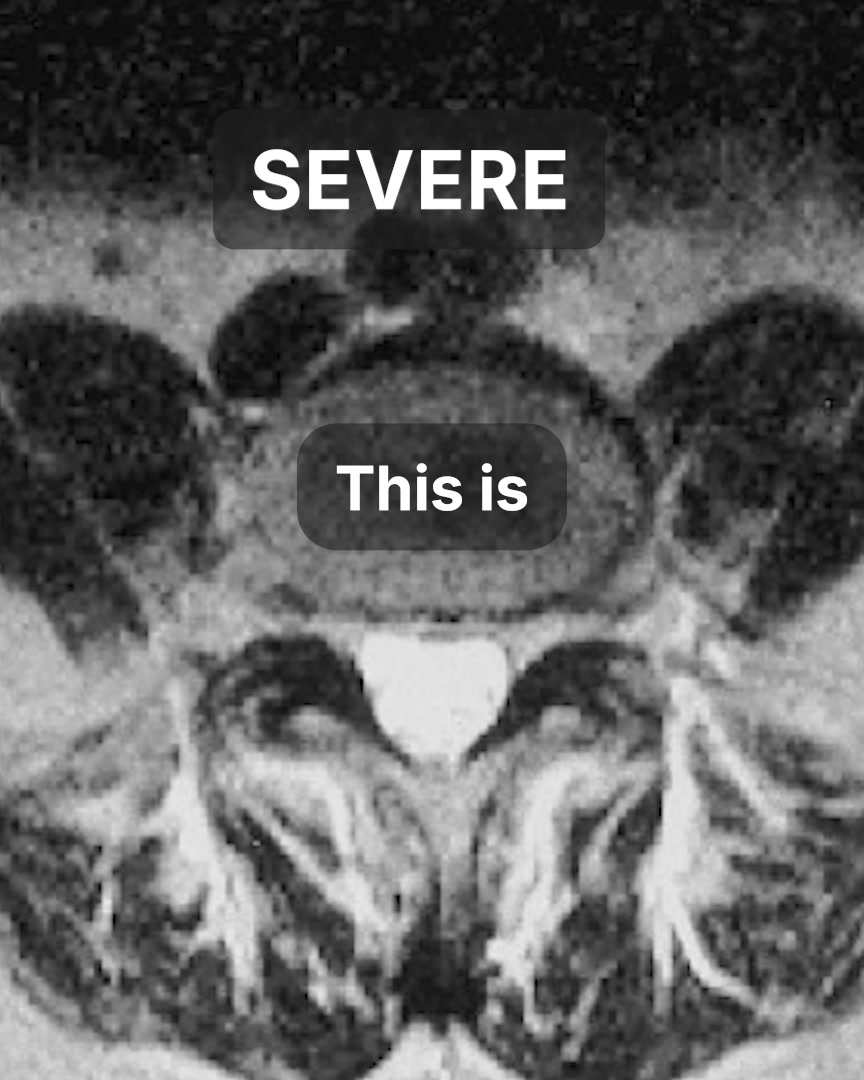 The white streaks on a spinal stenosis MRI