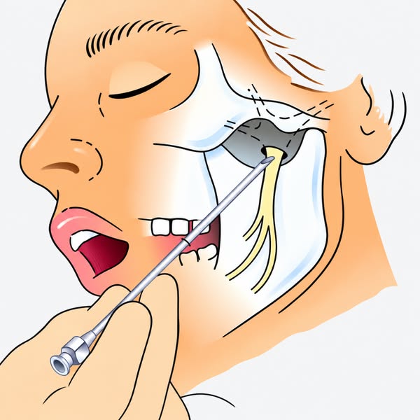 I charge £175 for a migraine infusion. My patients keep asking for a £24.95 roll-on that sits at reception.