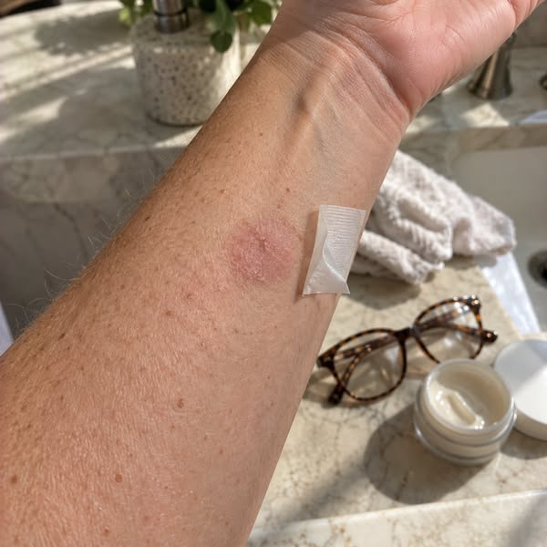 The patch test I finally didn't need