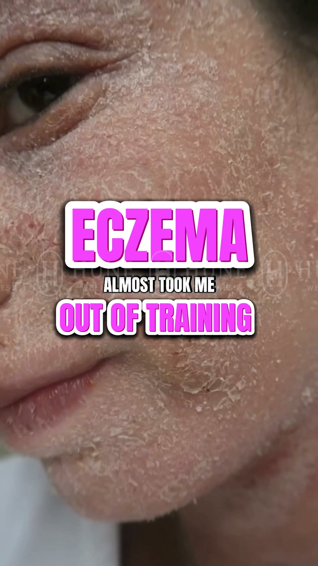 Psoriasis & Eczema Shouldn’t Control Your Whole Day