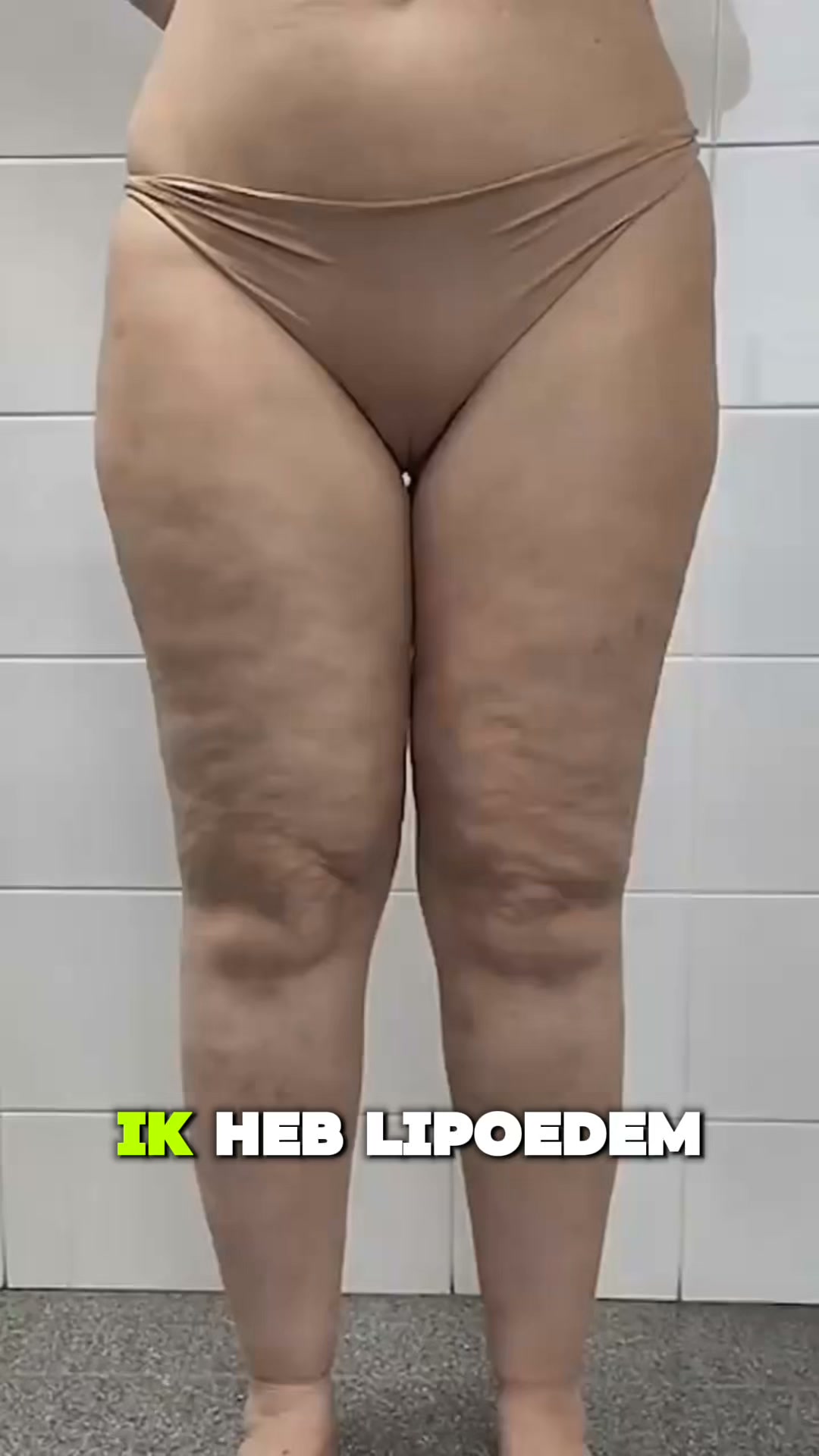 Strakkere benen. Gladdere look. Meer zelfvertrouwen.
