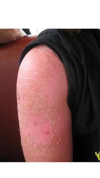 La vérité sur le "bronzage classique"