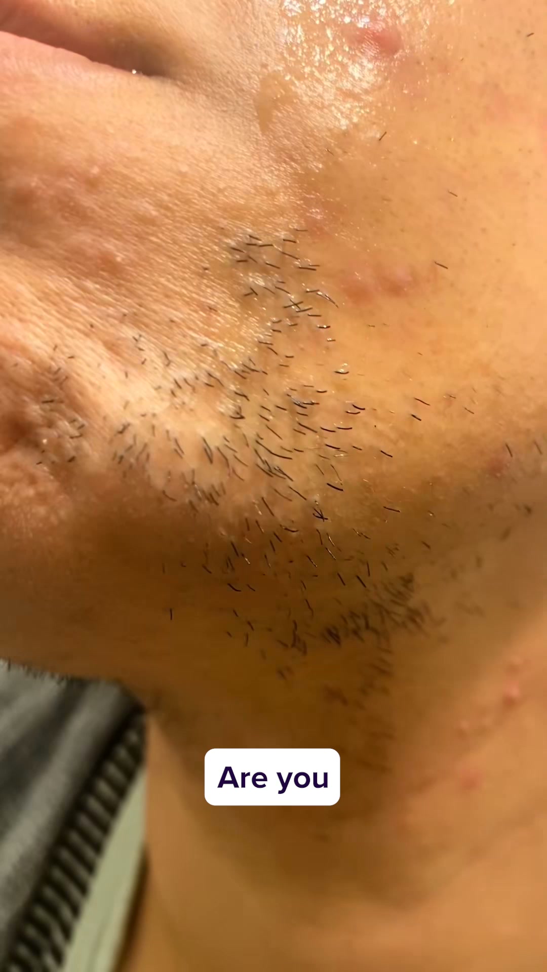 Dermaplaning, Made Effortless