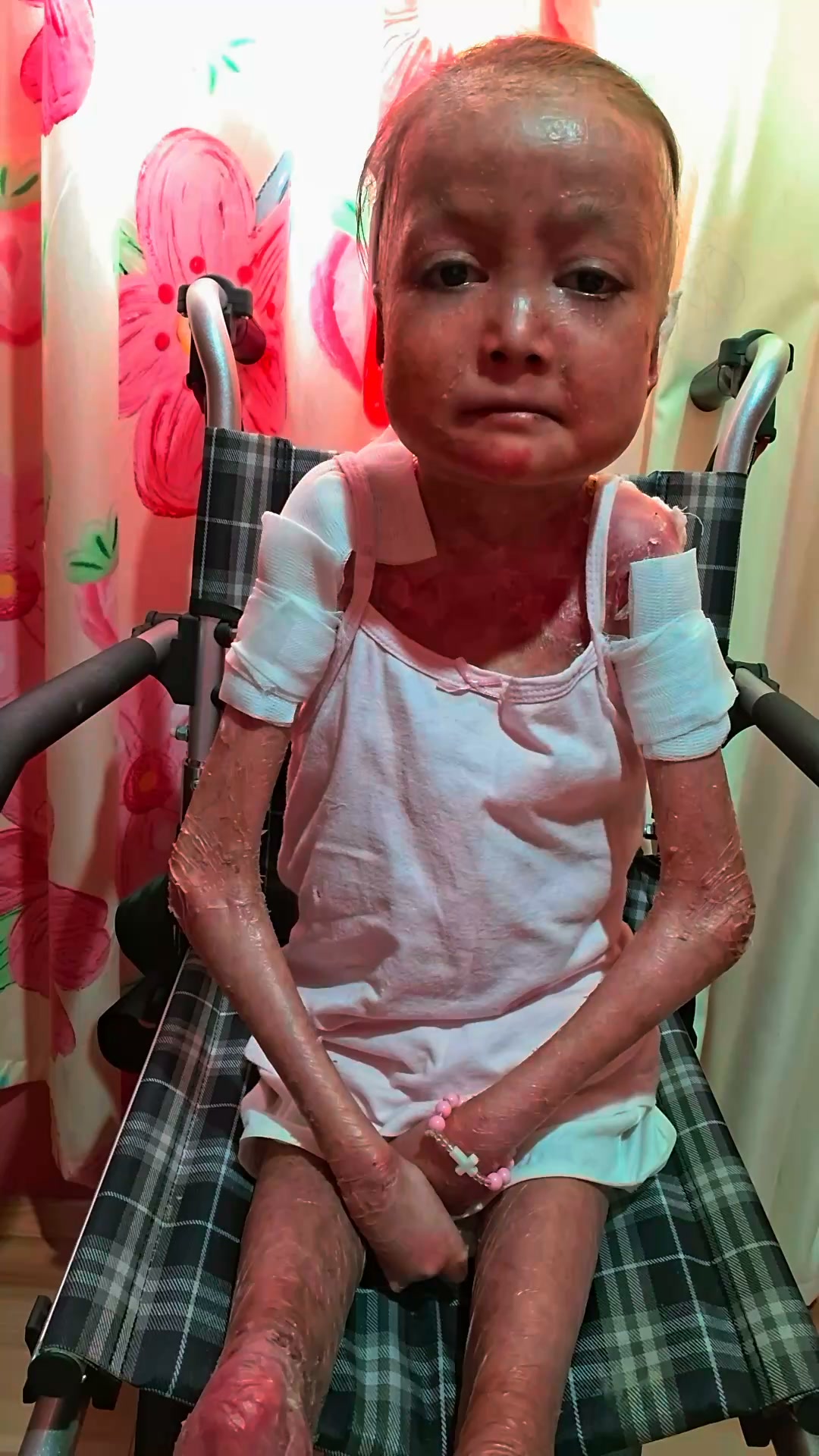 Shamila’s Skin Is Falling Off. Help Her.