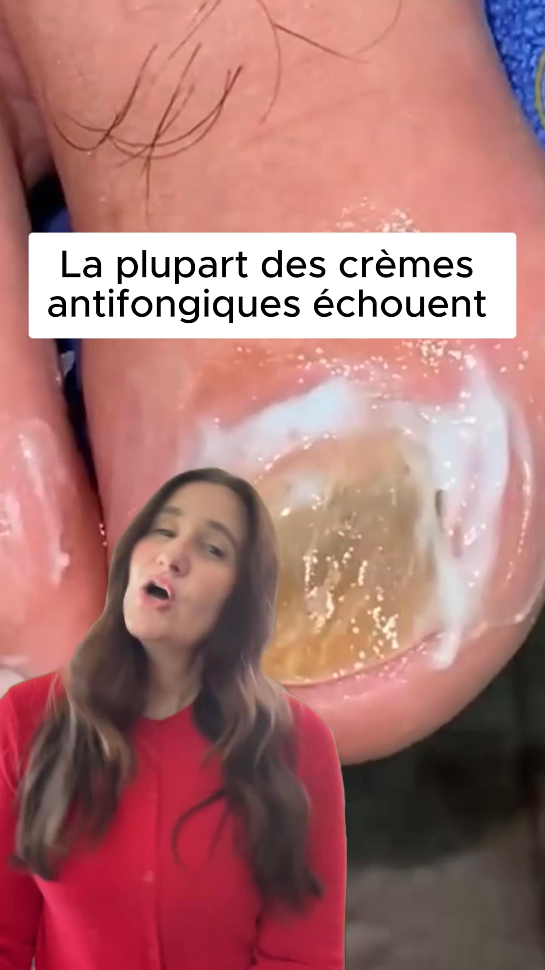 Élimine les mycoses des ongles au contact ‼