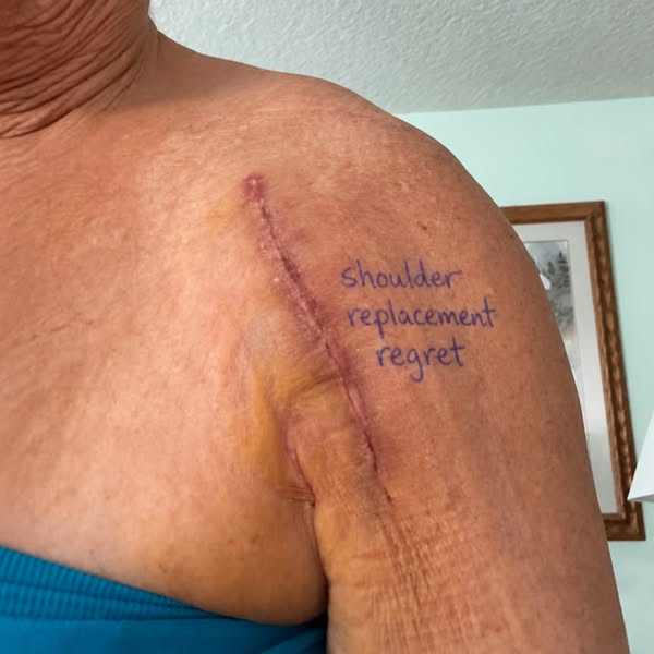 43 nights since my shoulder replacement