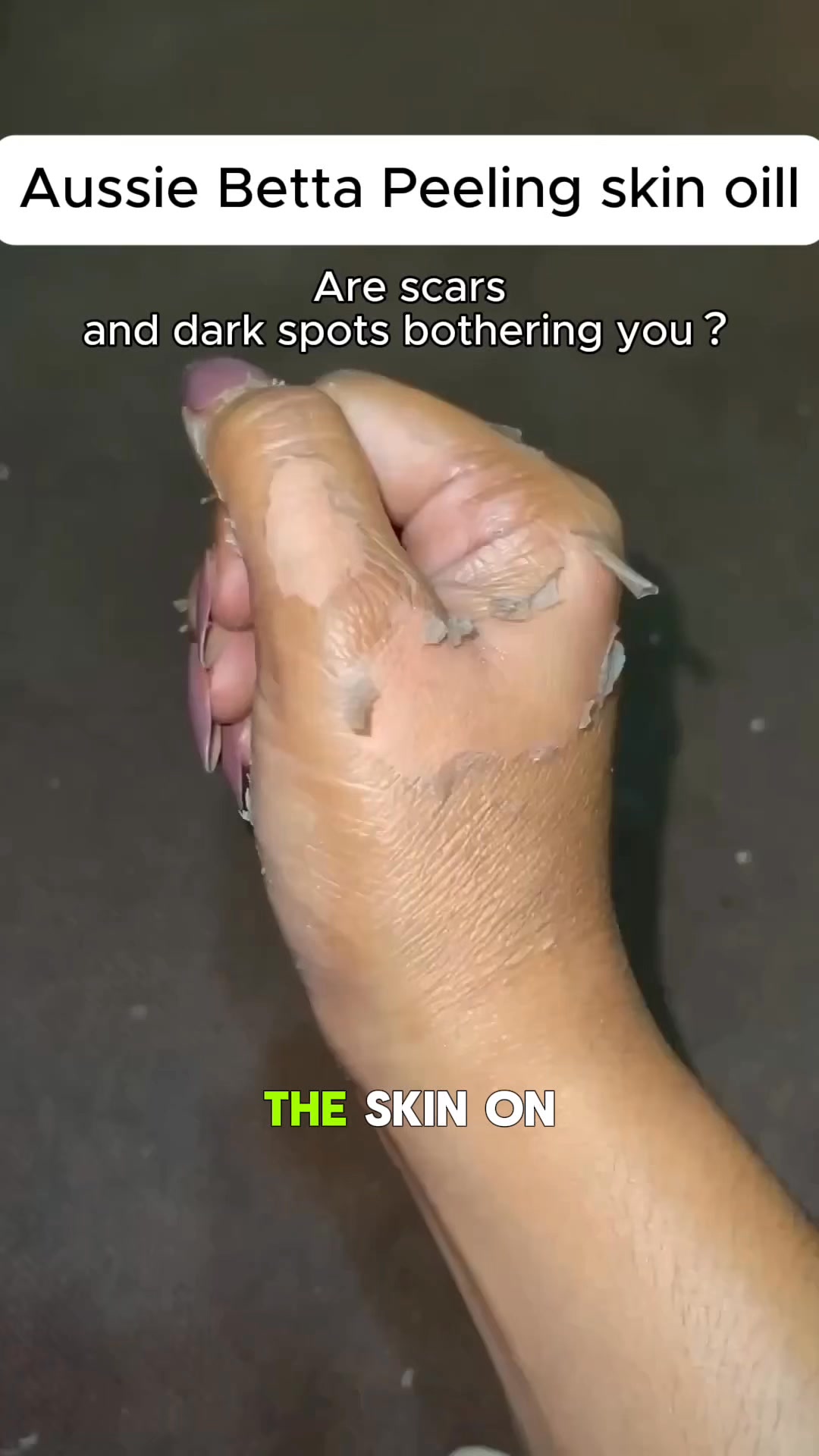 Aussie Betta Yellow Peeling Oil: Gentle Body Hyperpigmentation Treatment | Fade Dark Spots in 2 Weeks