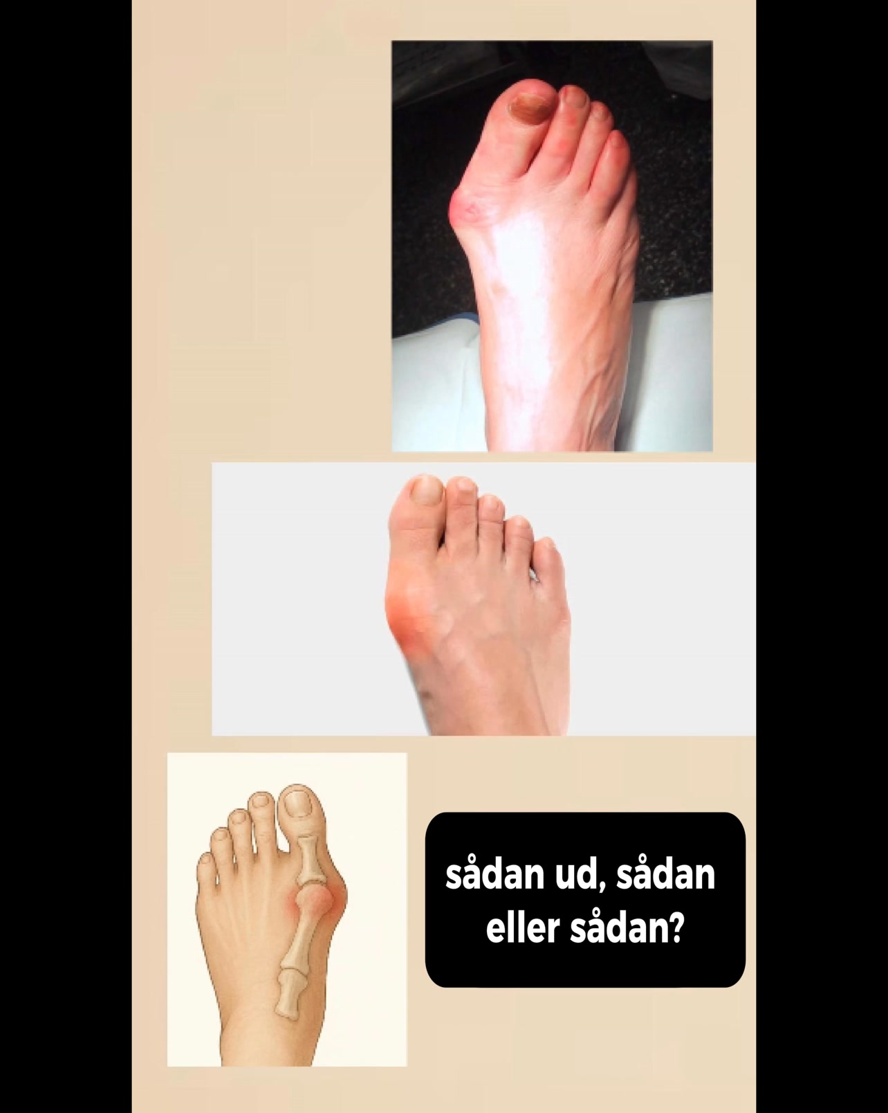 Har du en skæv storetå?