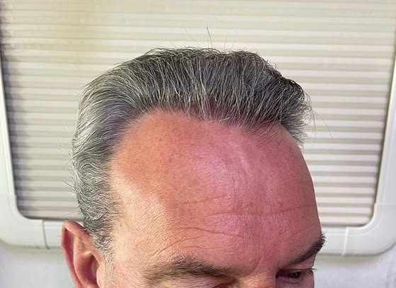 FueGenix | Exclusive Hair Transplant