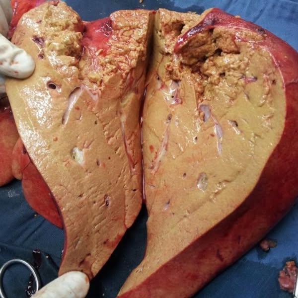 Why Liver Supplements Stall