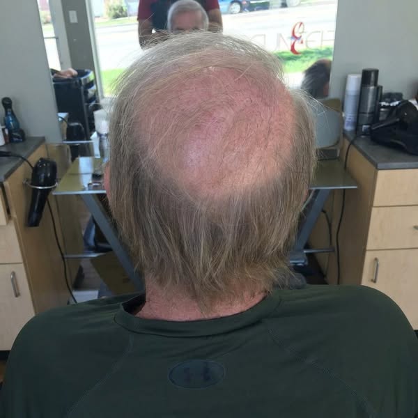 I Thought Minoxidil and Finasteride Were My Only Options. I Was Wrong.