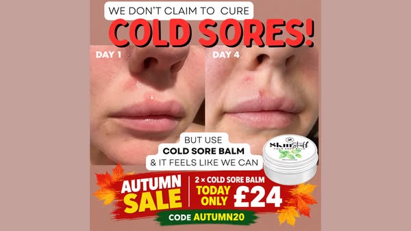 Cold Sores? 2 × Cold Sore Balm JUST £24!
