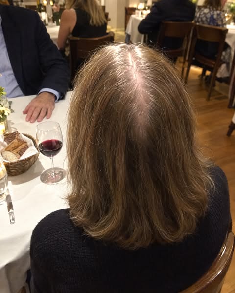 Offered minoxidil for life or a wig? Read this