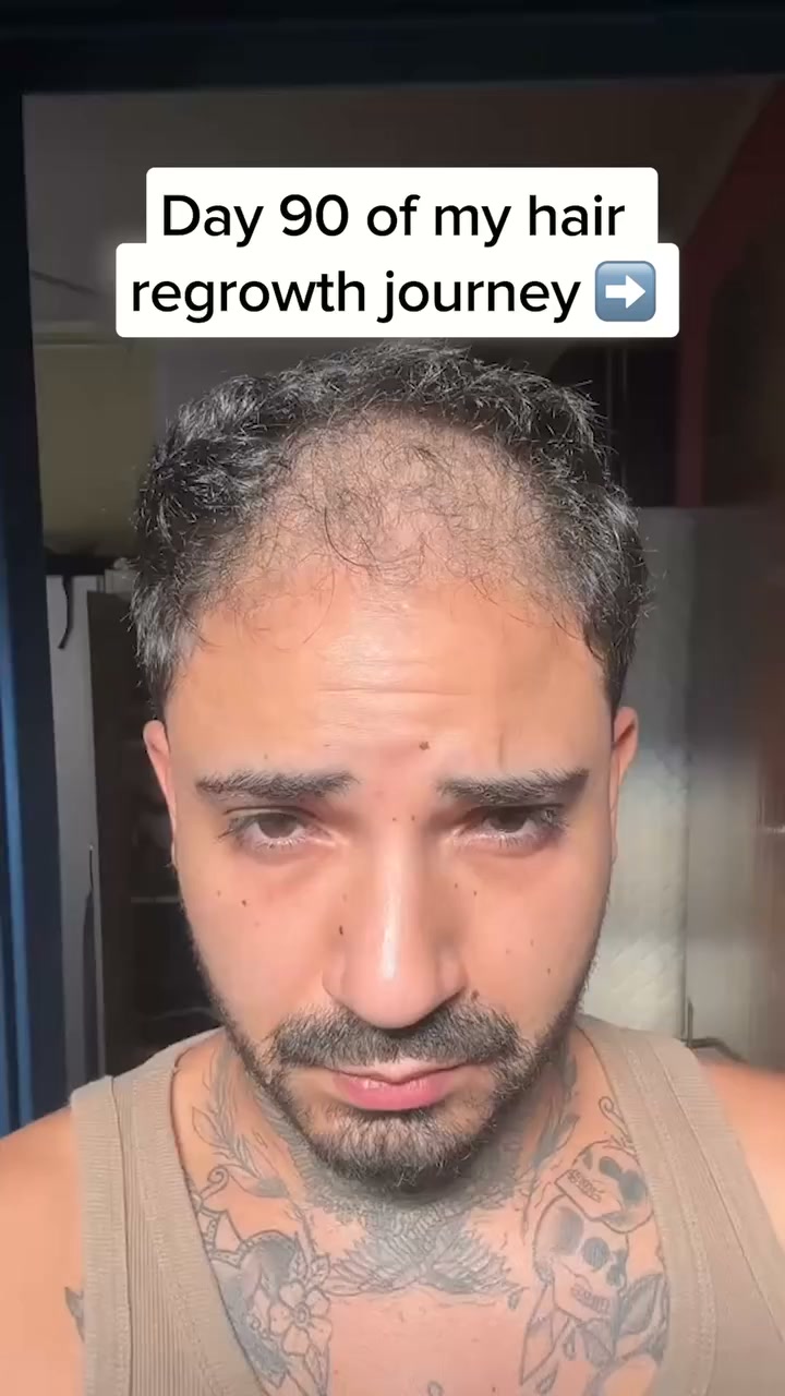 Regrow Hair Fast with AlphaInfuse