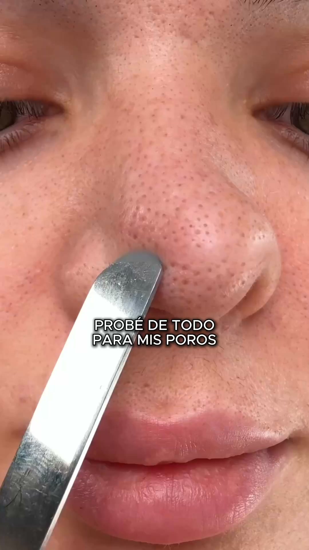 Adiós puntos negros - Sin tiras