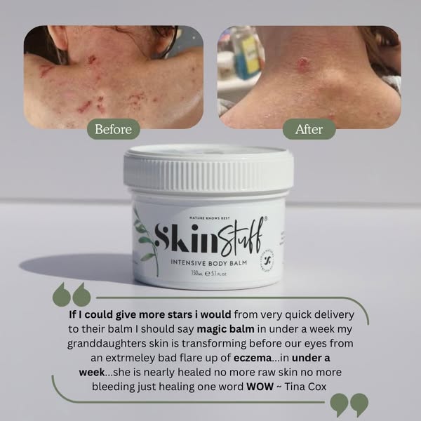 Calm Dry, Itchy Skin Naturally