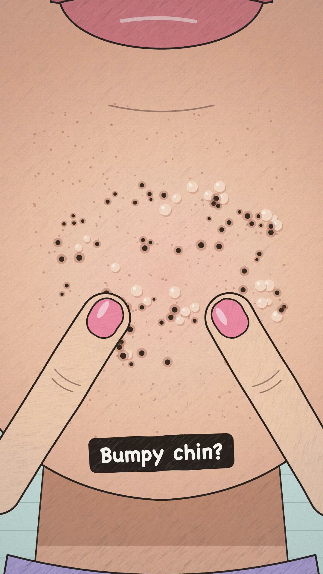 Say goodbye to blackheads