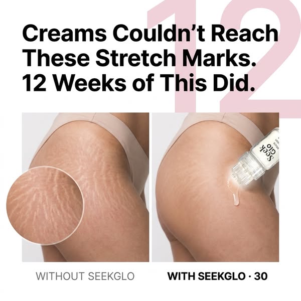 Stretch Marks? Try This At Home