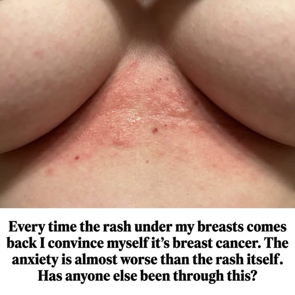 Is This Rash Breast Cancer?