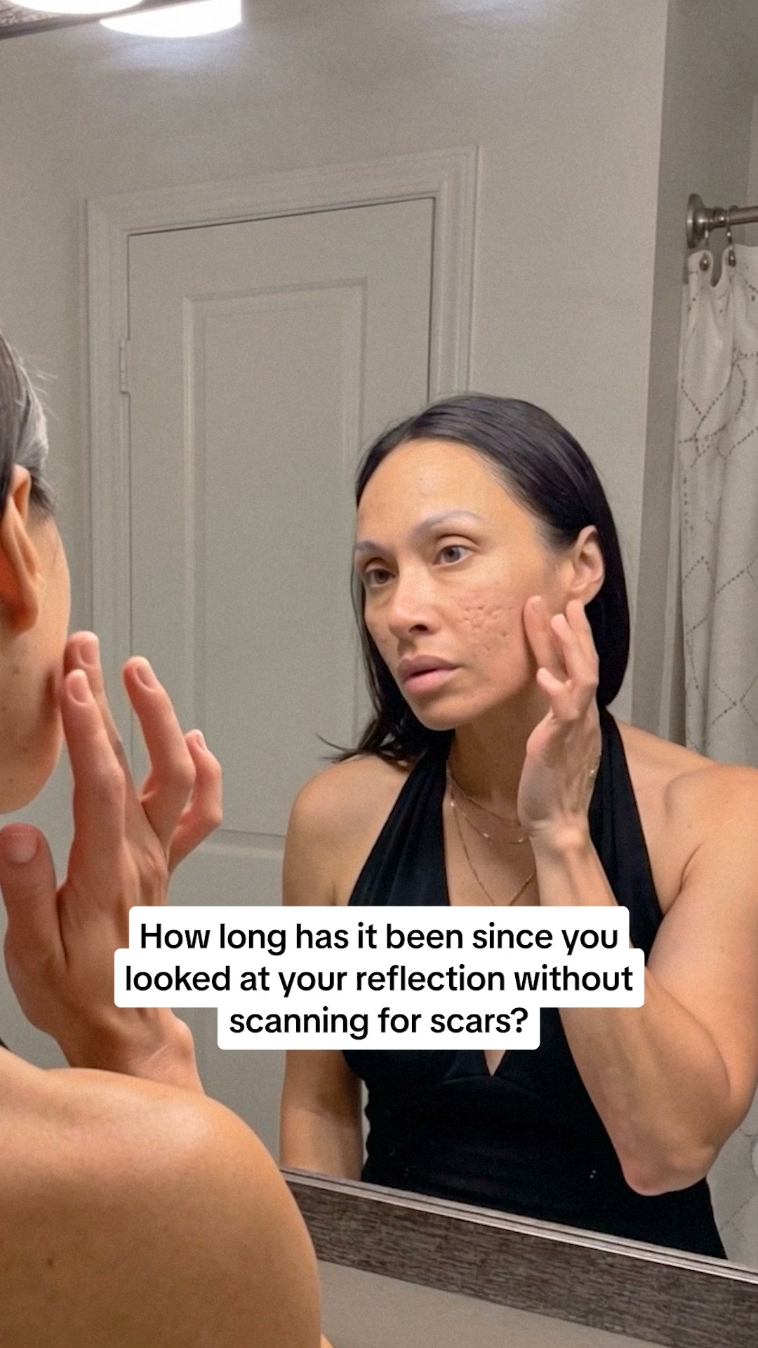PDRN Heals Acne Scars