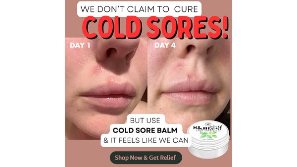 Natural cold sore relief.