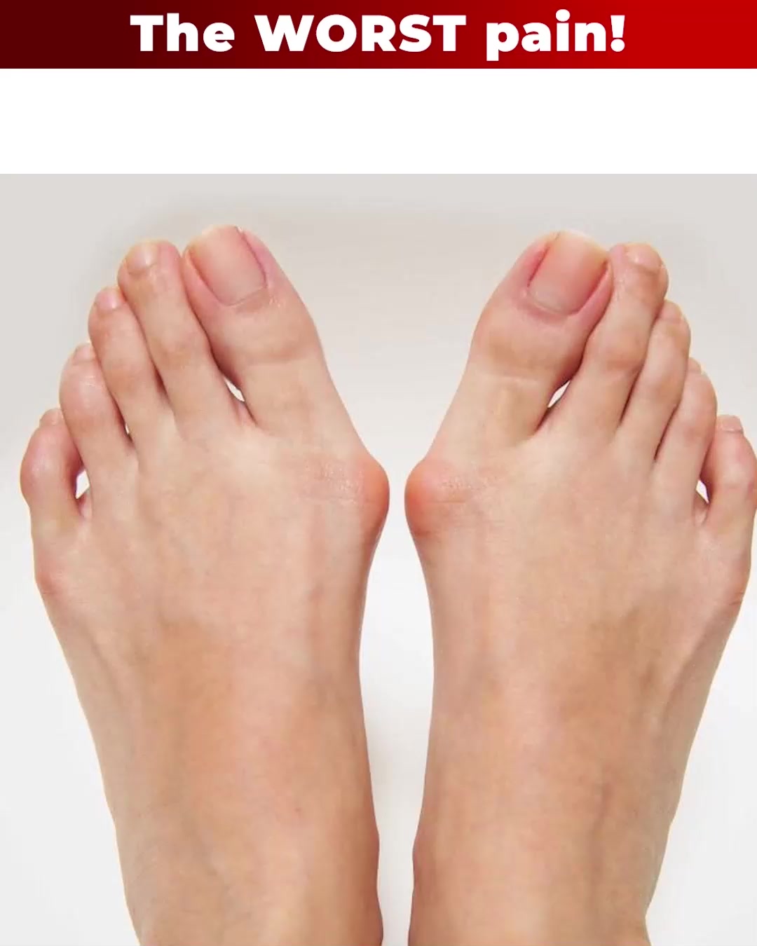 No More Bunion Discomfort!
