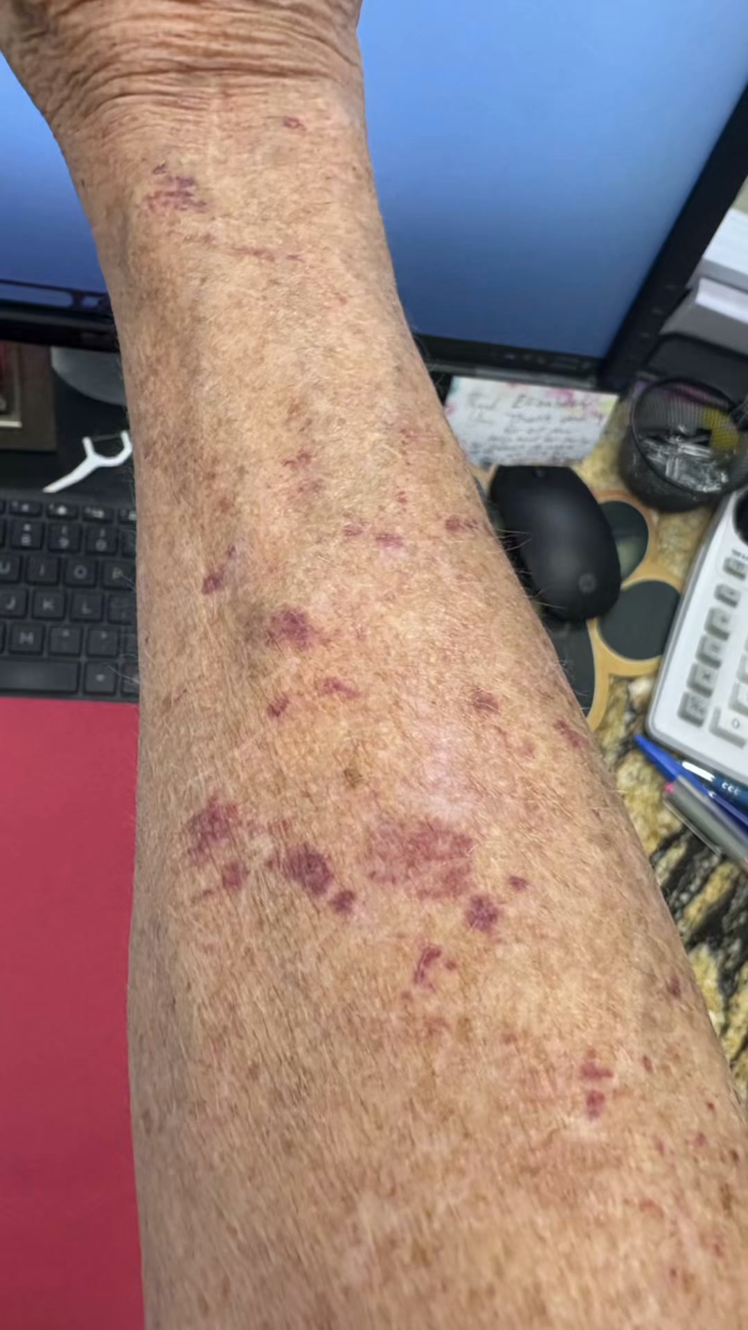 Bruises Gone In Days!