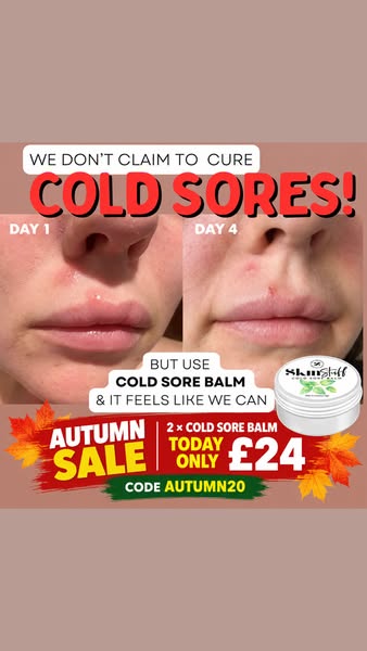 Cold Sores? 2 × Cold Sore Balm JUST £24!