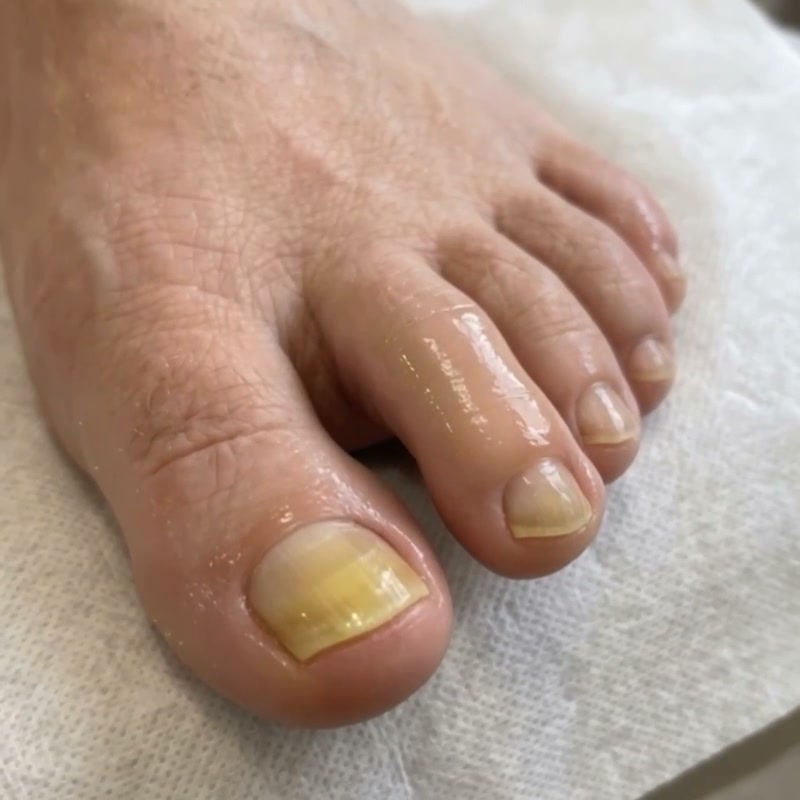 Tiefenwirksame Nagelpilz-Pflege | Laborgeprüft & Sicher