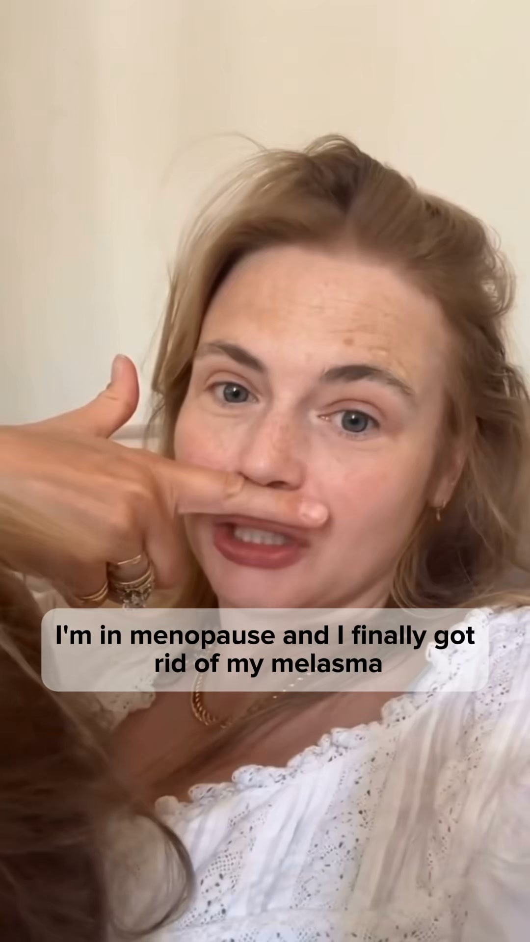Stop Covering Melasma With Makeup, Do This Instead