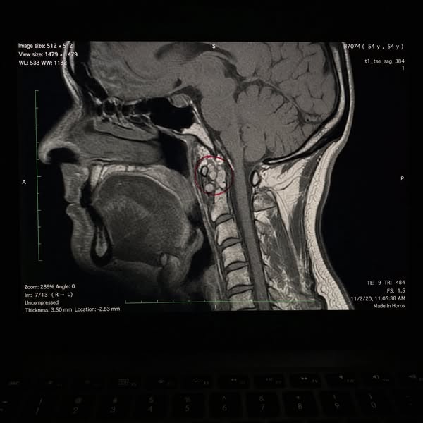 I Thought It Was Depression. My Lymph Was Backed Up.