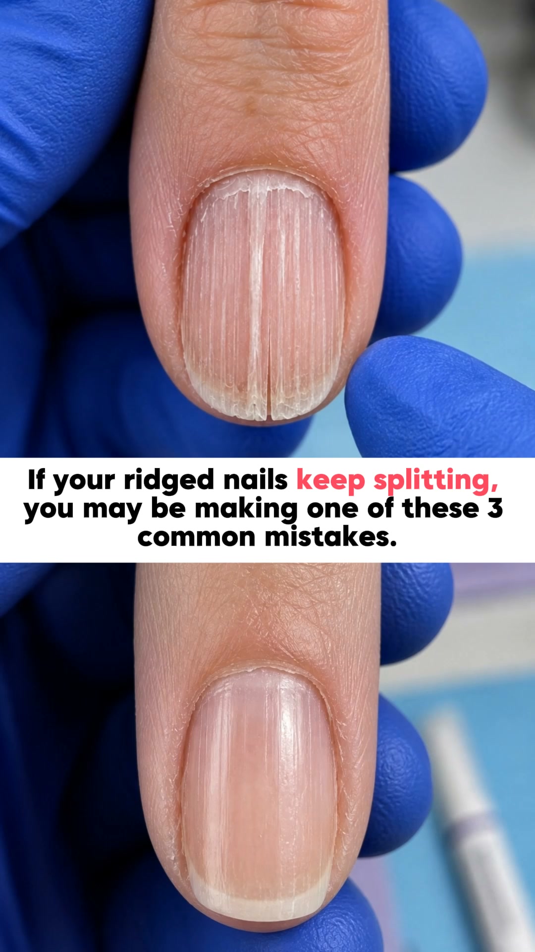 Why Nails Get Ridges After 50