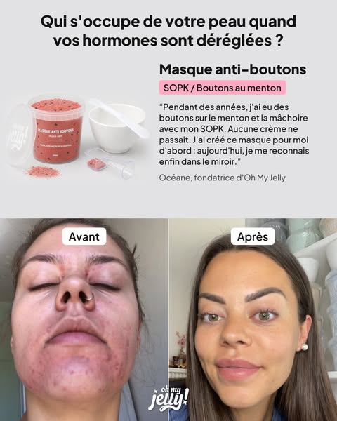 SOPK : 91 % ont vu leurs boutons réduits en 4 semaines. Sans toucher aux hormones.