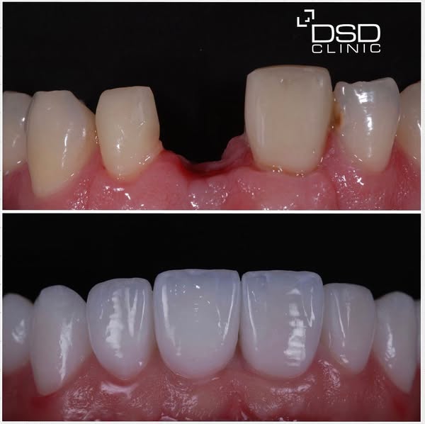 Restore Your Smile with Implants