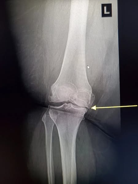 Women with arthritis: your heart is next