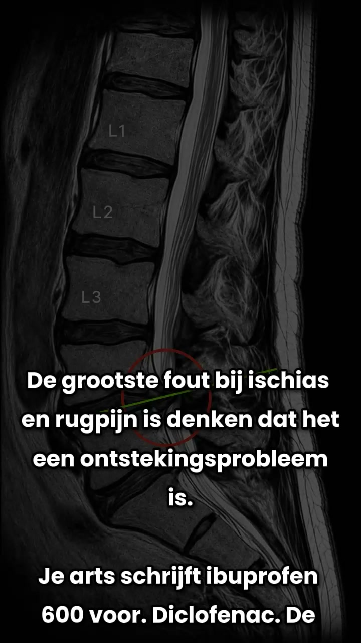 Als je last hebt van ischias, moet je dit lezen