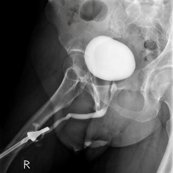 65 To 75 Percent Of TURP Patients Lose Sexual Function.