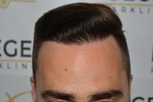 Art Gallery | FueGenix | Hair Restoration Artistry