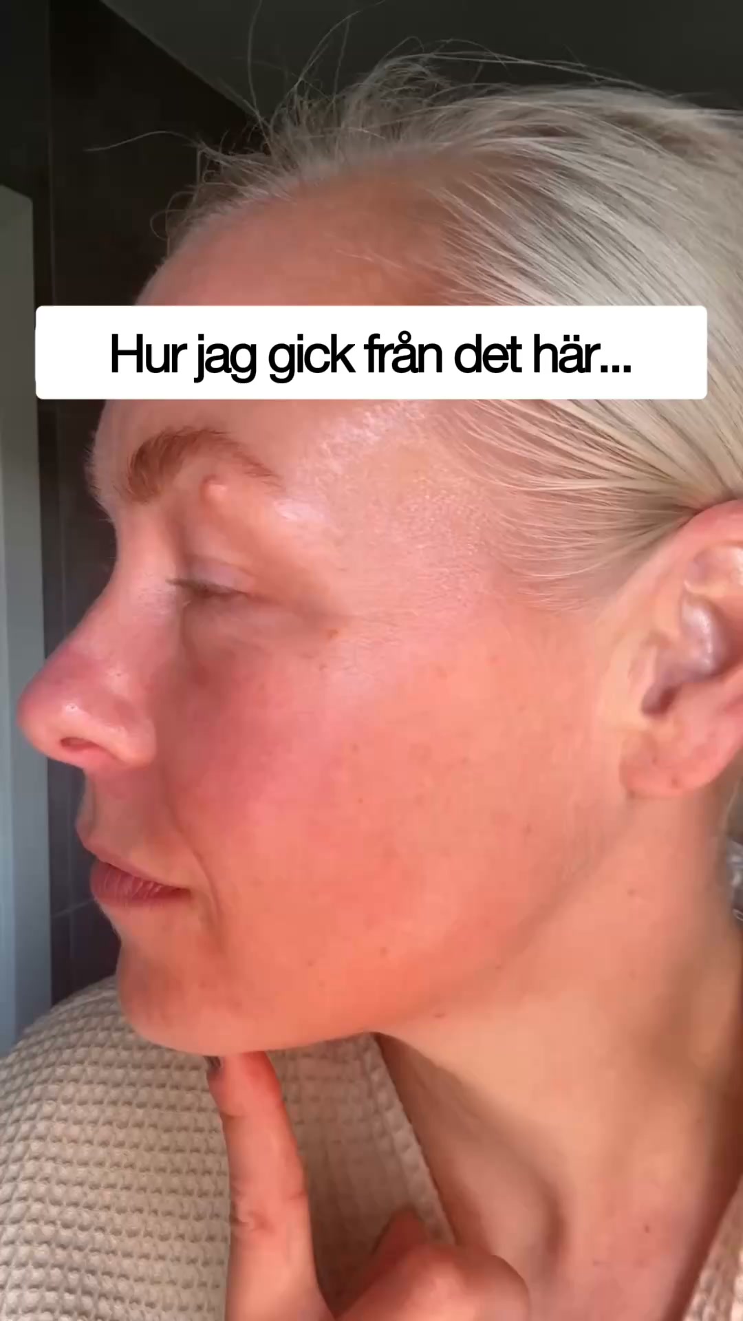 Slätare linjer utan botox