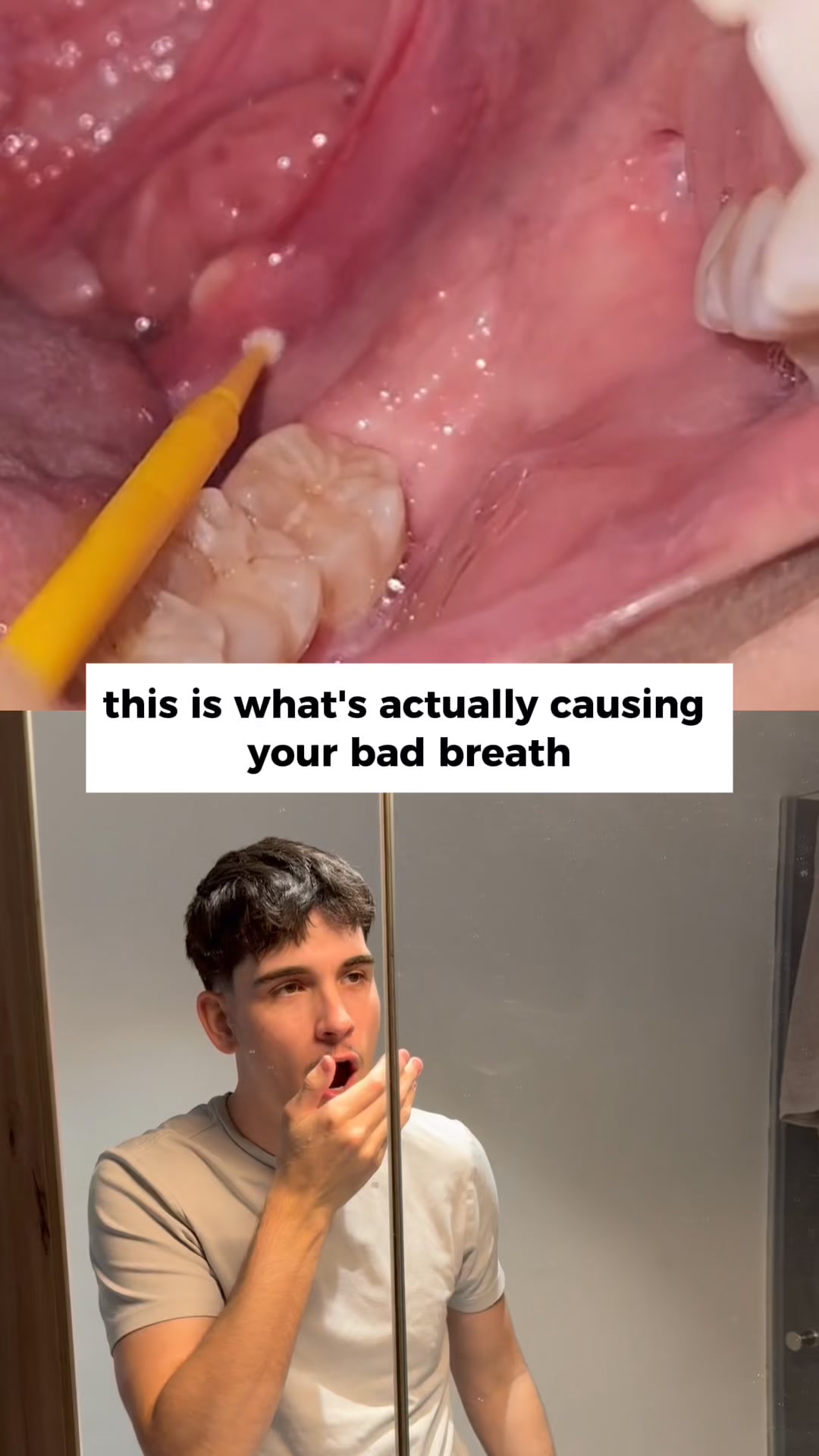 The Tonsil Stone Remover You Didn't Know Existed