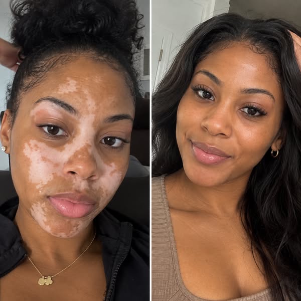 Fast and easy fix for vitiligo.