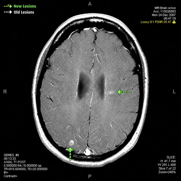 My Neurologist Wanted to Escalate Me to Ocrevus After 3 Years of Failed Protocols.