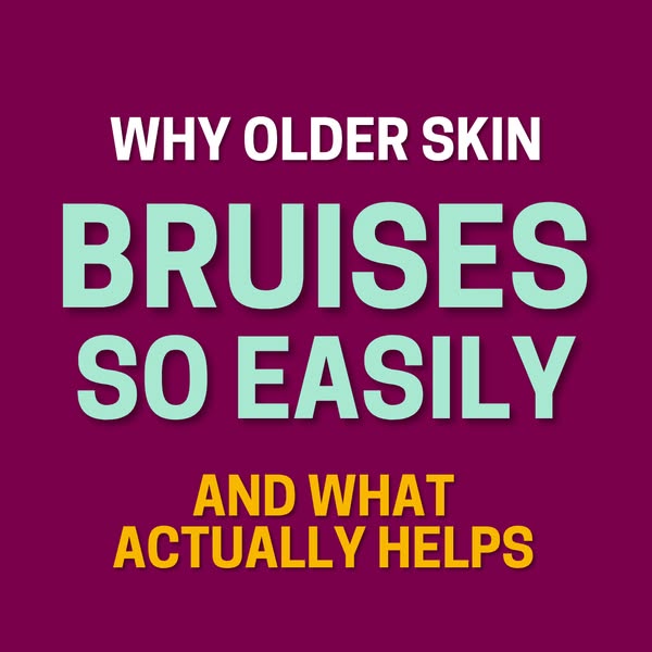 Why Older Skin Bruises Easily: Understanding the Causes