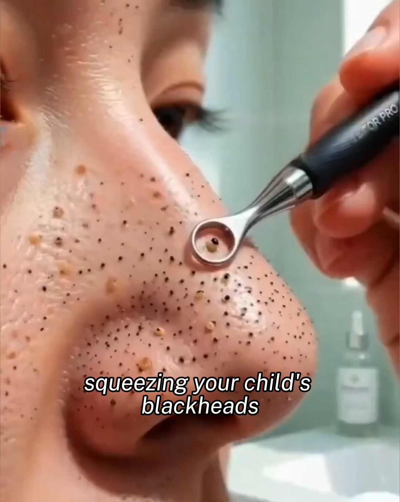 Stop acne now!