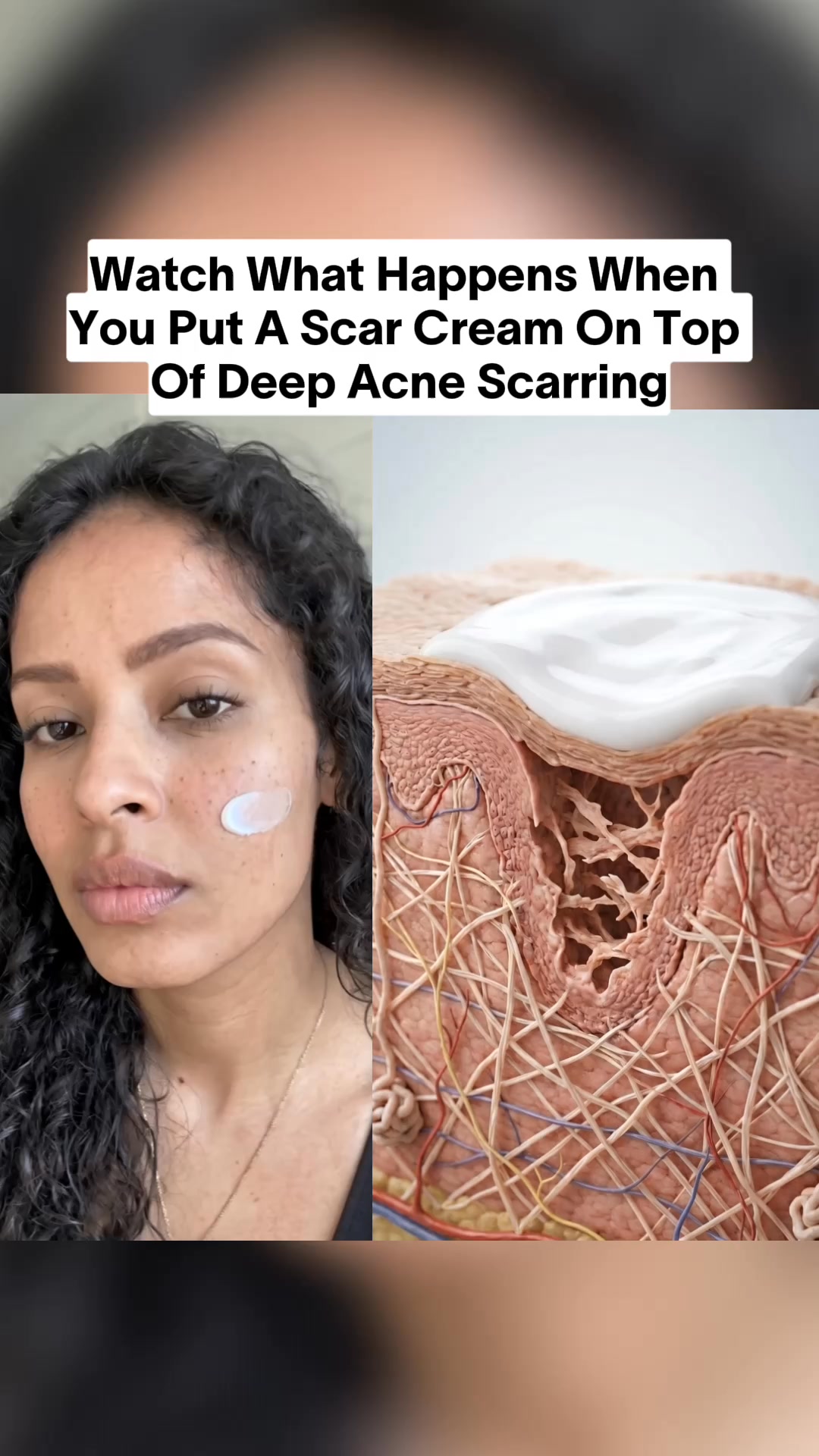 The Salmon DNA Repair Hack for Acne Scars