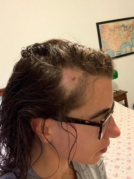 Je perdais mes cheveux depuis 3 ans. Celà n'avait rien à voir avec le stress