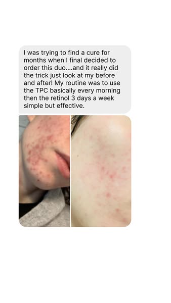 Reduce pigmentation without irritation.