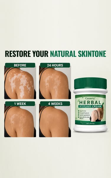 Fast and easy fix for vitiligo.
