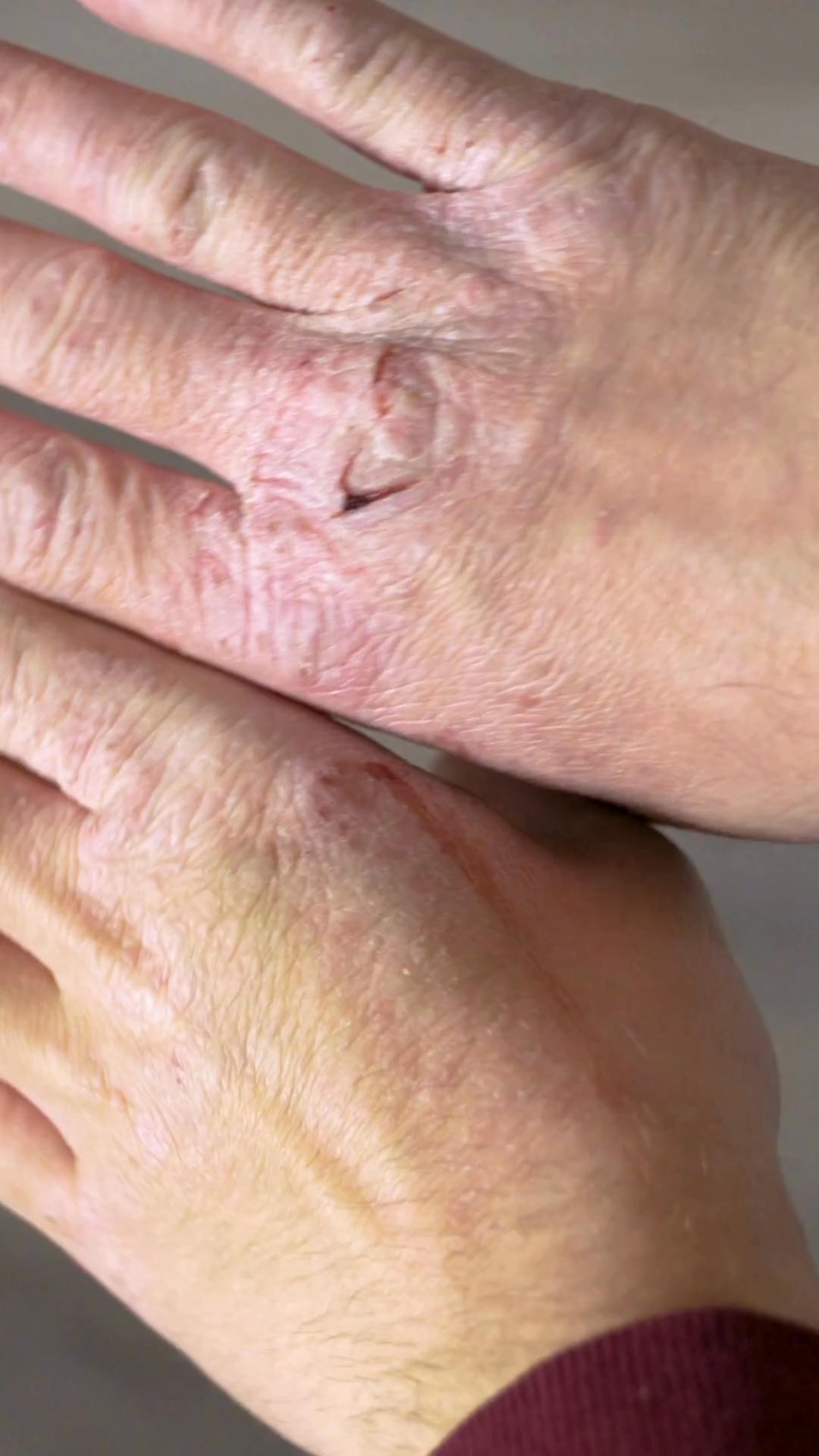 2-Step Spray-Cream Therapy System
